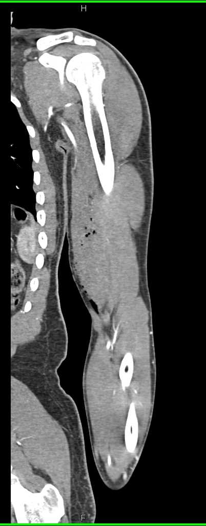 Stab Wound Arm Without Vascular Injury - CTisus CT Scan