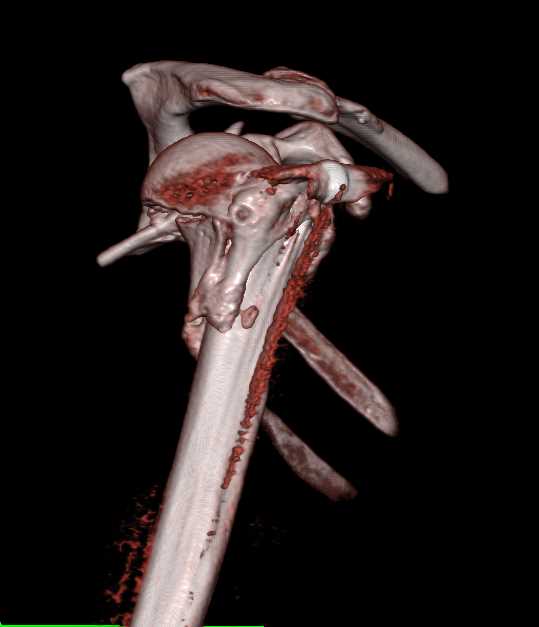 Fracture and Dislocation of the Humerus - CTisus CT Scan