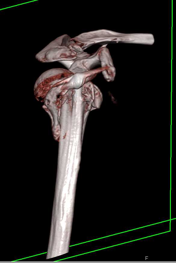 Fracture and Dislocation of the Humerus with Pin in Humerus - CTisus CT Scan