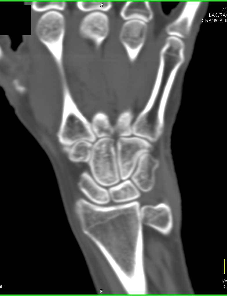 Normal Carpal Bones Post Trauma - CTisus CT Scan