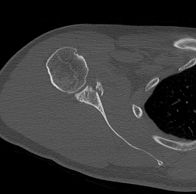 Shoulder Trauma with Glenoid Fracture - CTisus CT Scan