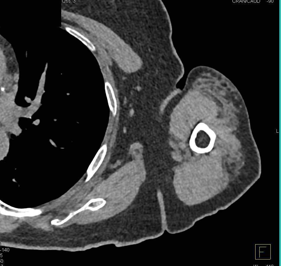 Humerus Neck Fracture with Associated Hematoma - CTisus CT Scan