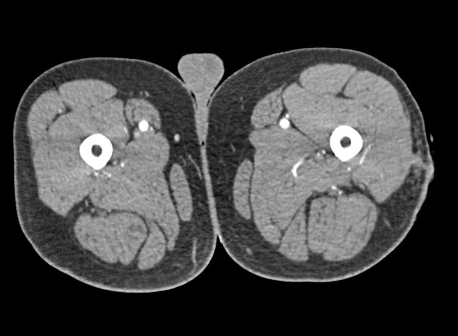 Stab Wound Without Active Extravasation - CTisus CT Scan