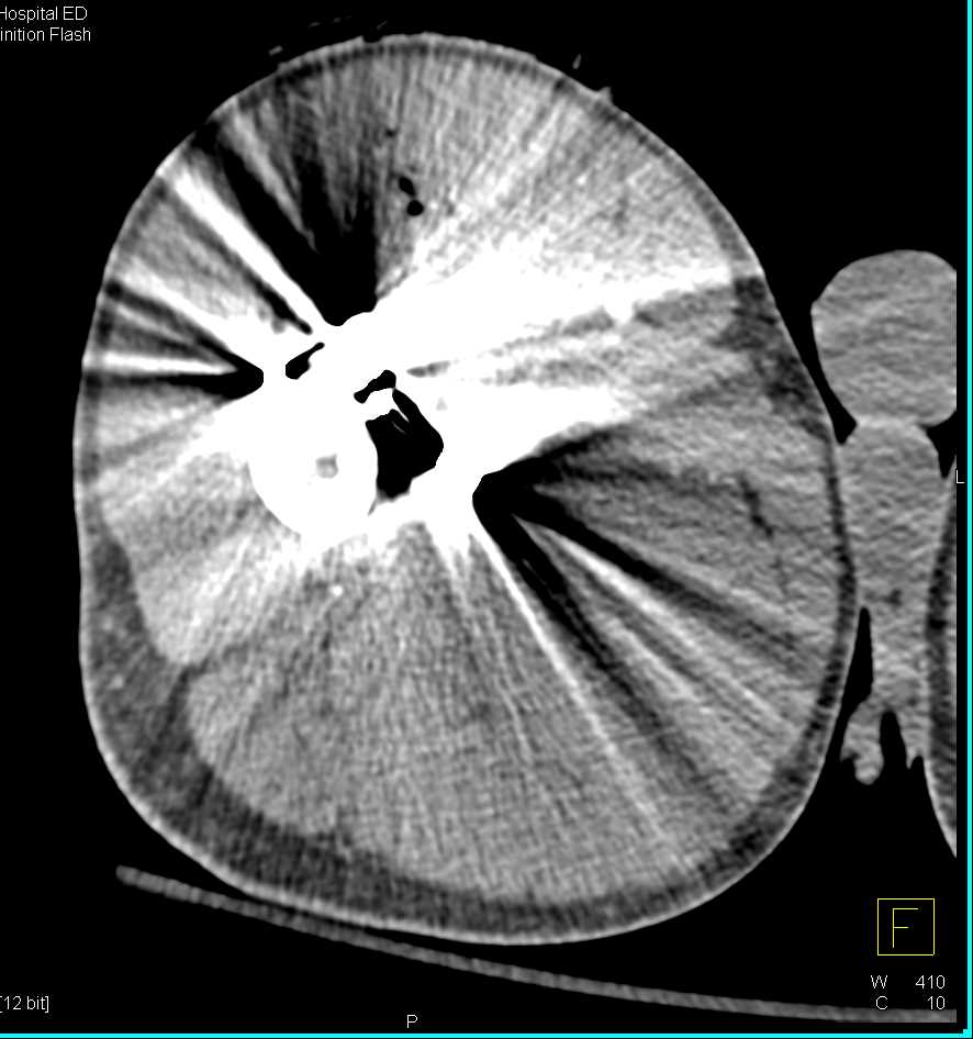 GSW Thigh Without Vascular Injury - CTisus CT Scan