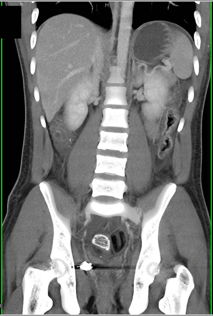 GSW Pelvis Without Bladder Injury - CTisus CT Scan