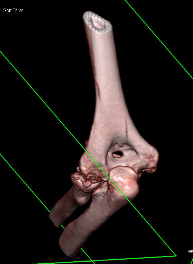 3D Rendering of Complex Elbow Fracture and Dislocation - CTisus CT Scan