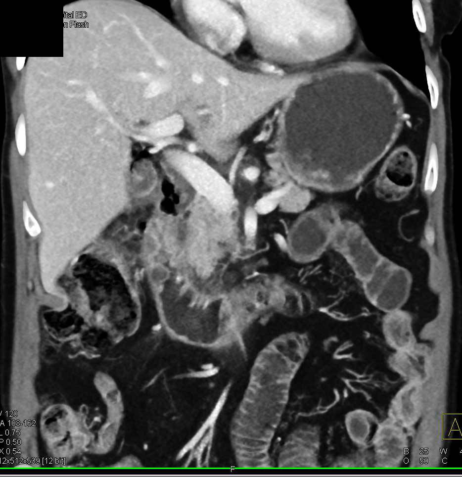 Duodenal Perforation Following Endoscopy with Fluid and Extraluminal Air - CTisus CT Scan