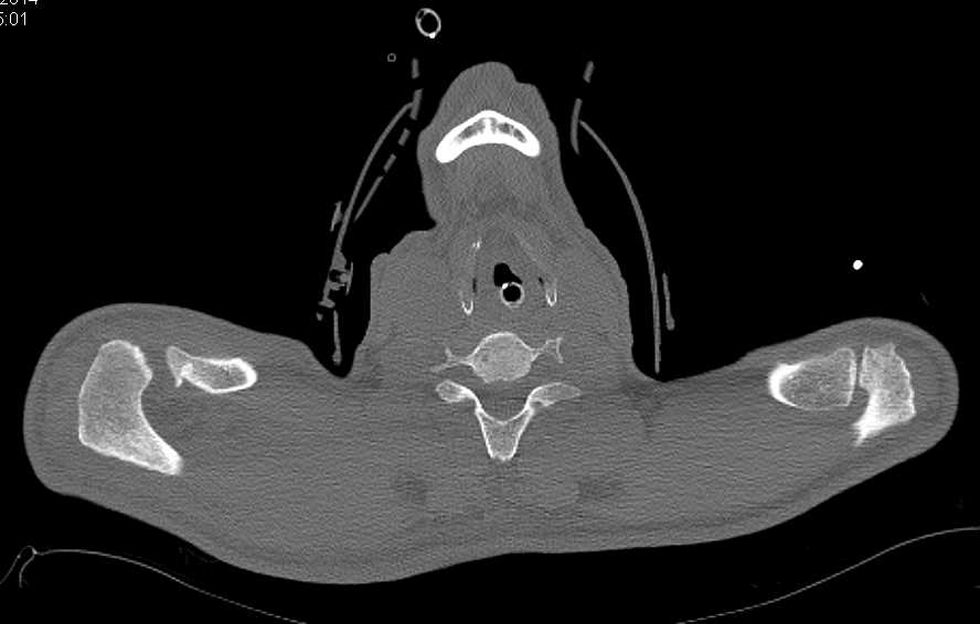 Trauma with Scapular Fracture and Widening Acromion-Clavicular Joint - CTisus CT Scan