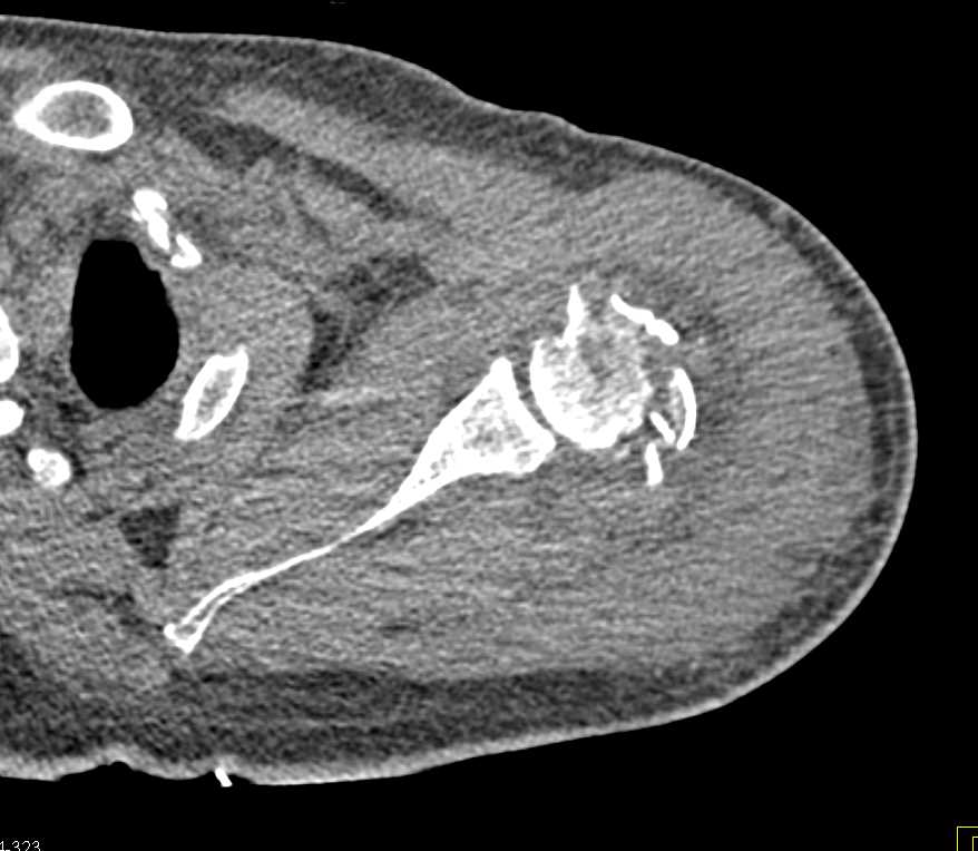 Comminuted Fracture Greater Tuberosity Humerus - CTisus CT Scan