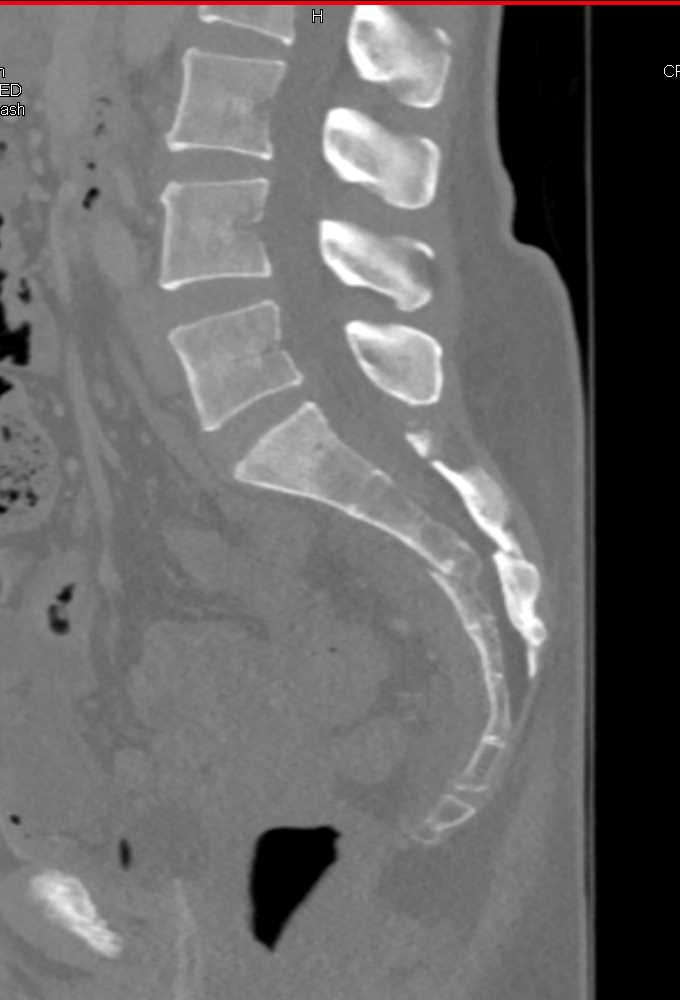 3D of a Sacral fracture - Trauma Case Studies - CTisus CT Scanning