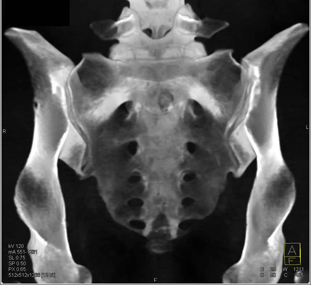 3D of a Sacral fracture - CTisus CT Scan