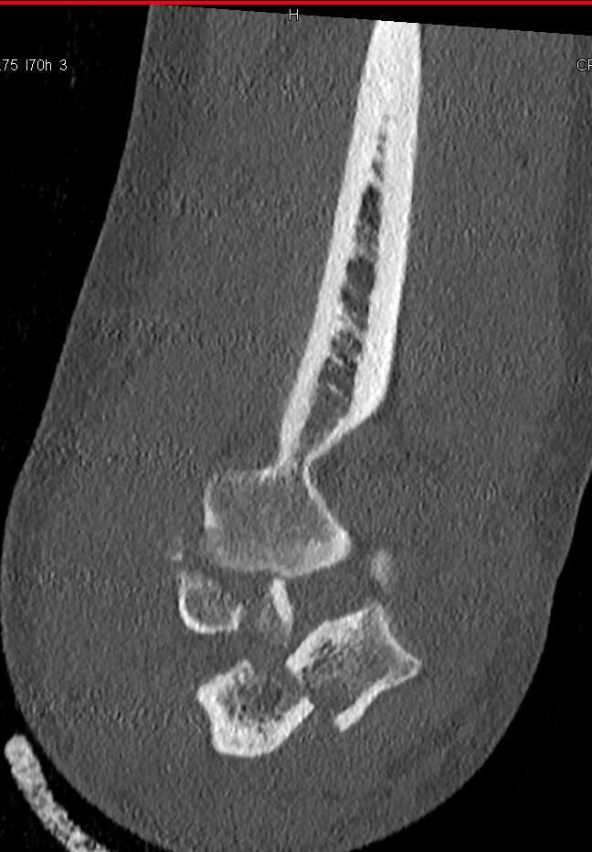 3D Map of Fracture/Dislocation Elbow with Multiple Fractures - CTisus CT Scan