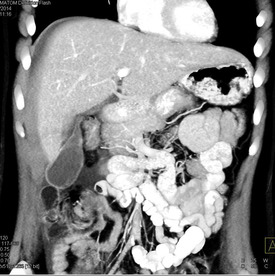 Liver Laceration and Bleed s/p Motor Vehicle Accident (MVA) - CTisus CT Scan