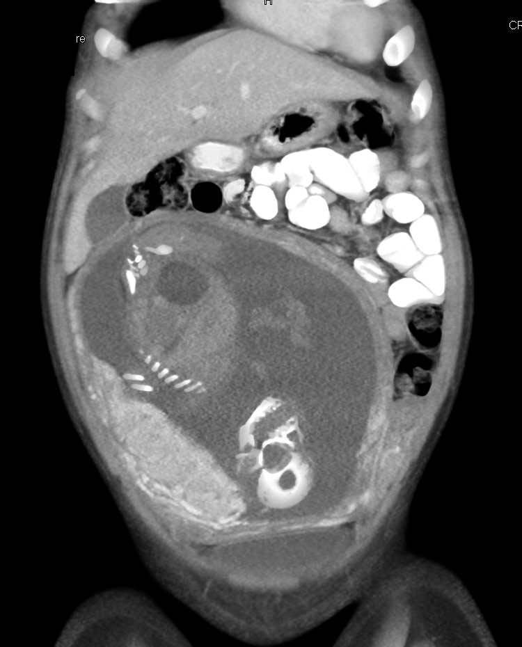 CT of Fetus in a Trauma patient - CTisus CT Scan