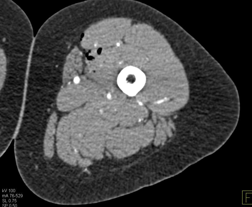 GSW Thigh Without Key Vascular Injury - CTisus CT Scan