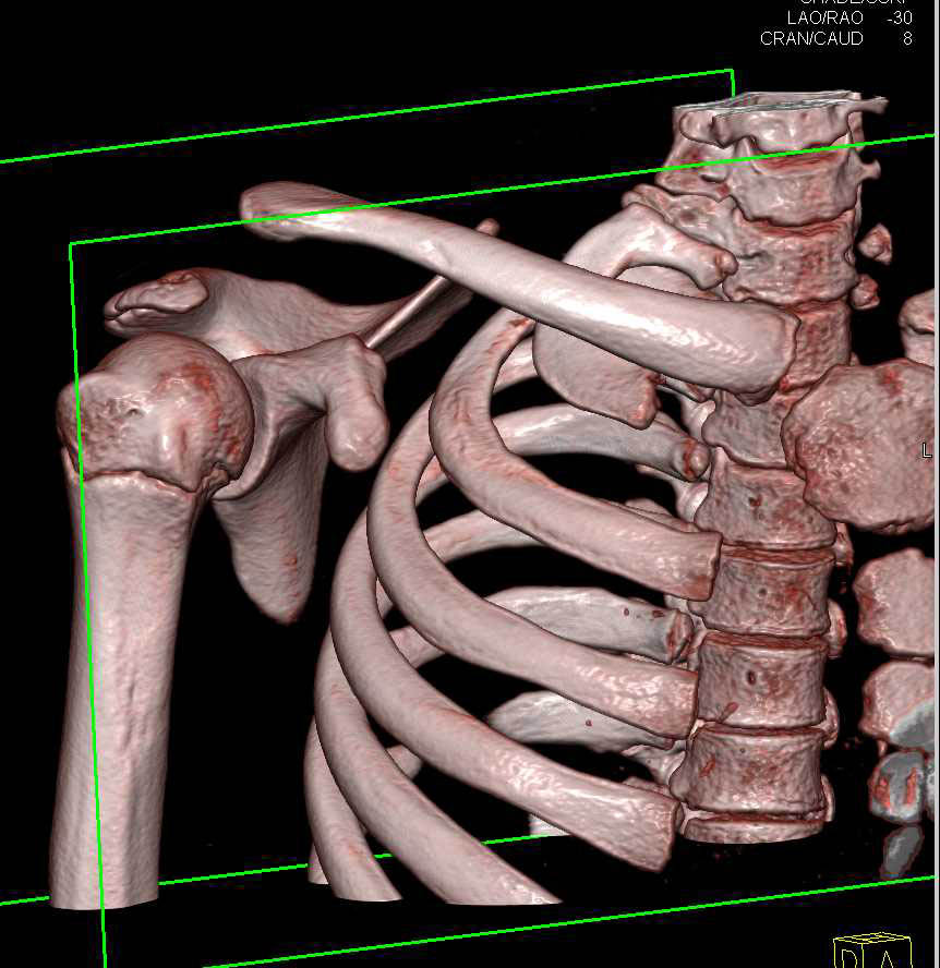 Trauma with Distal Clavicle Dislocation and Right Pneumothorax - CTisus CT Scan