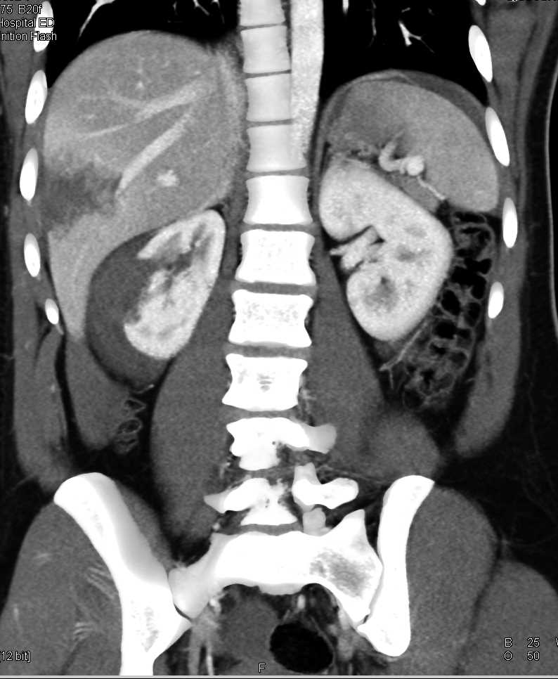 Trauma with Liver and Renal Lacerations with Bleed - CTisus CT Scan