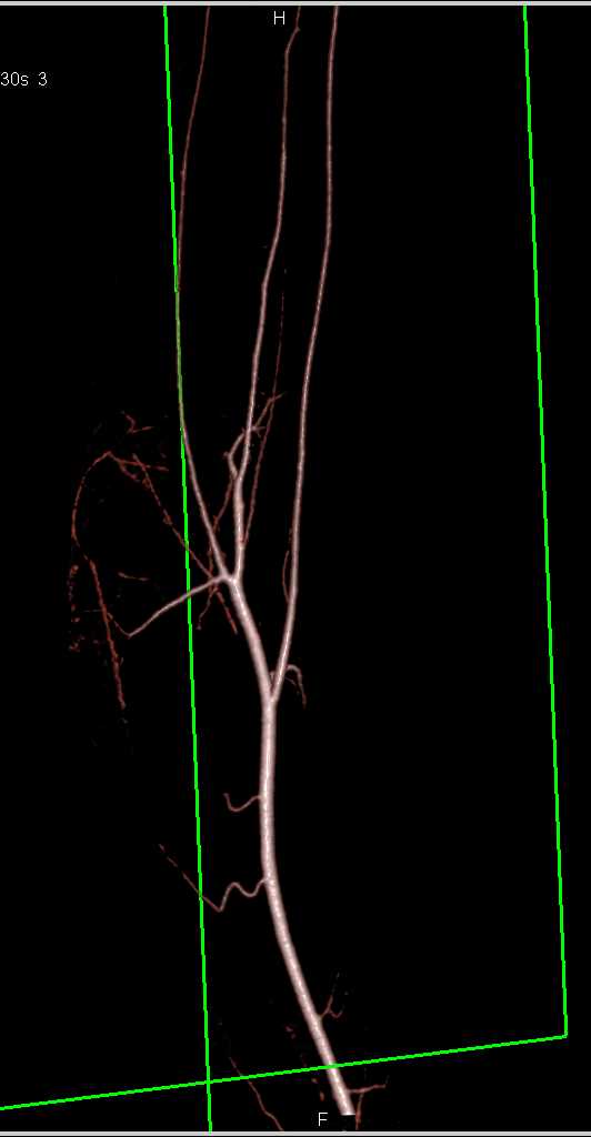 Stab Wound Without Vascular Injury - CTisus CT Scan