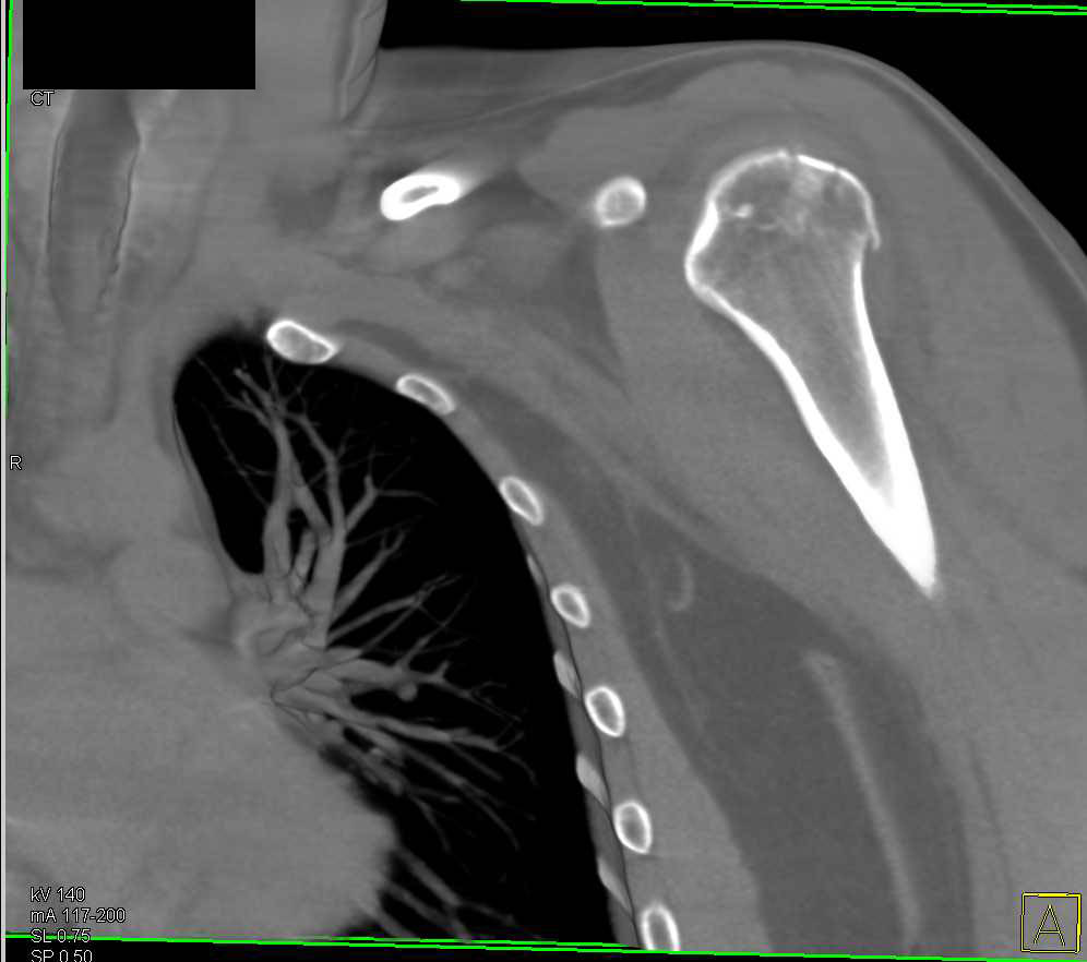 Fracture of Humerus - CTisus CT Scan