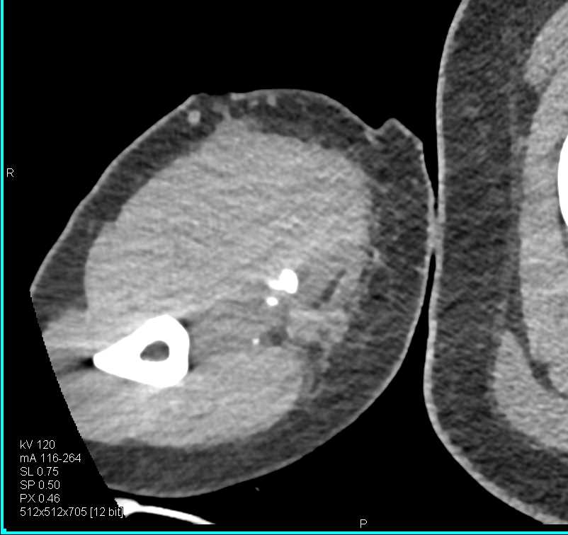 Pseudoaneurysm  Brachial Artery due to Trauma - CTisus CT Scan