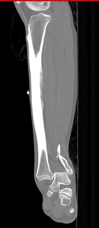 Fracture/Dislocation of the Ankle - CTisus CT Scan