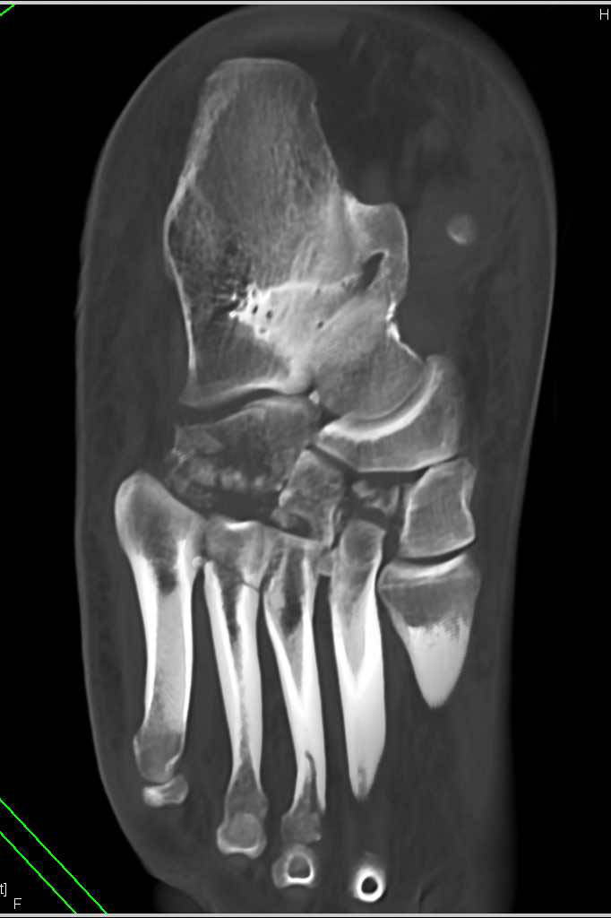 Lisfranc Injury with Multiple Fractures of Tarsals and Metatarsals ...