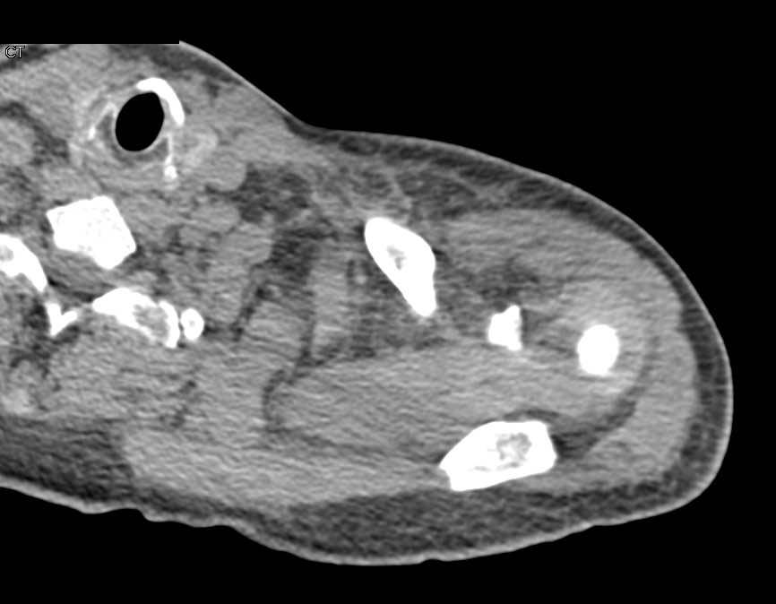 Fractures of the Scapula and the Clavicle - CTisus CT Scan