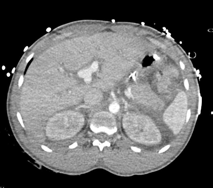 GSW with Bleed in Left Thigh and Colon Injury - CTisus CT Scan