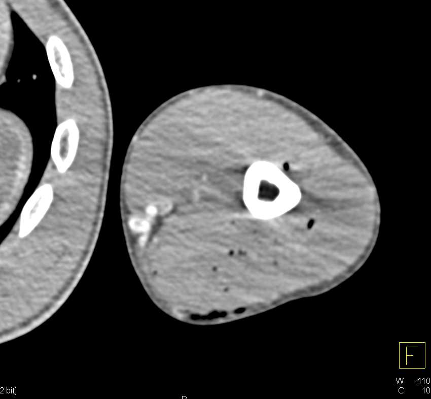 GSW Arm Without Critical Vascular Injury - CTisus CT Scan