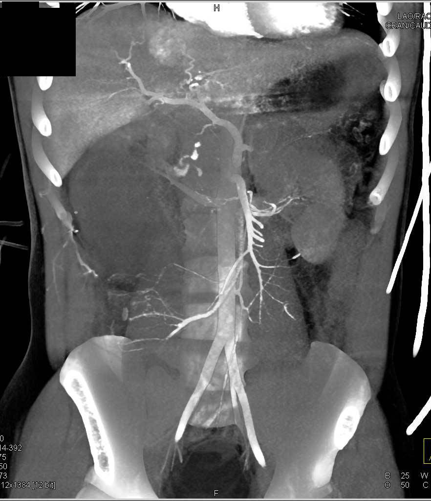 Trauma with Renal and Duodenal Injury with Active Bleed - CTisus CT Scan