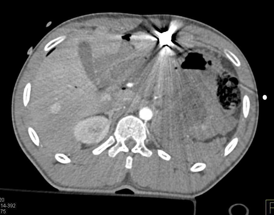 GSW with Renal and Duodenal Injury with Active Bleed Defined - CTisus CT Scan