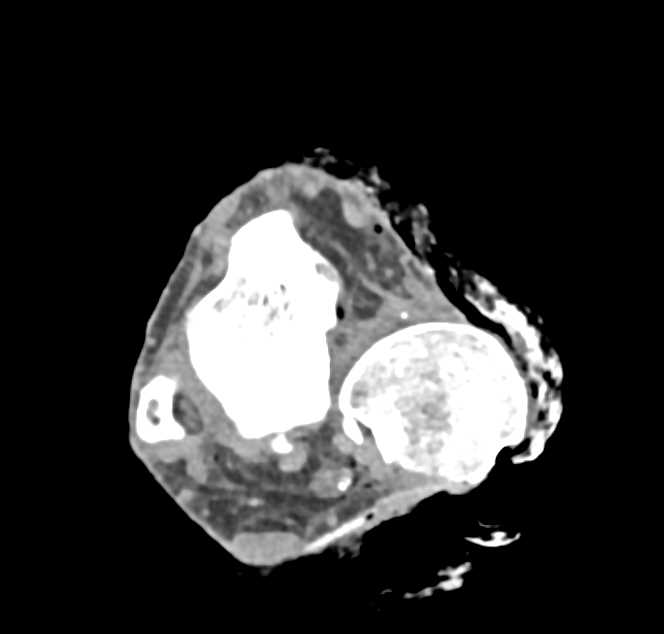 Open Fracture Dislocation of Ankle Joint - CTisus CT Scan