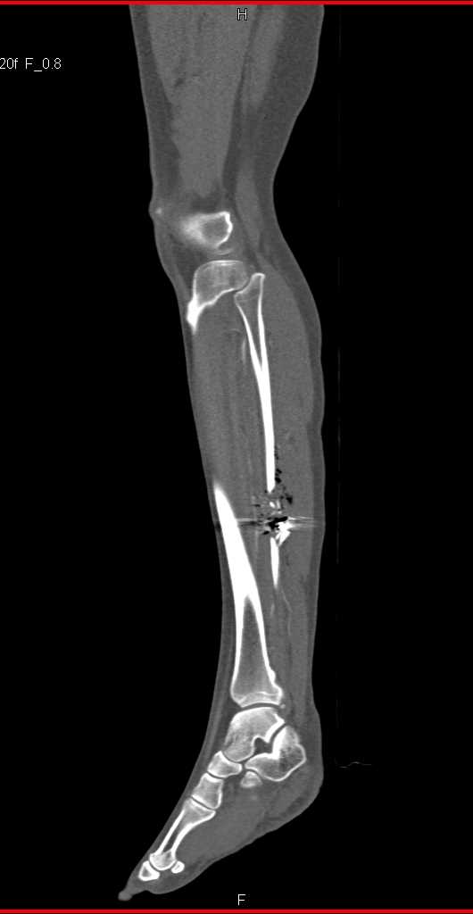 GSW Calf with Fractures but no Vascular Injury - CTisus CT Scan