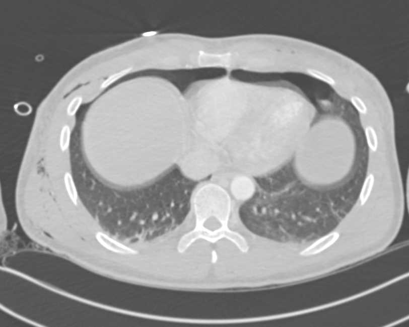 Liver Laceration and Hemoperitoneum with Multisite Trauma - CTisus CT Scan