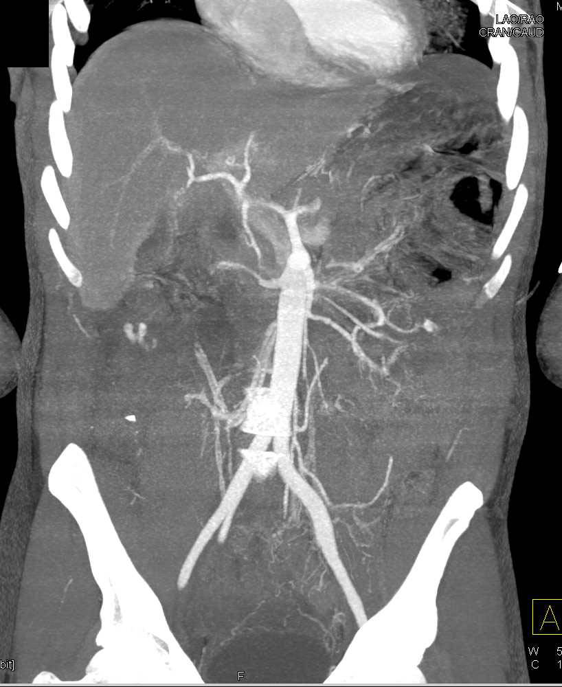 GSW with Active Bleed in Right Lower Quadrant - CTisus CT Scan