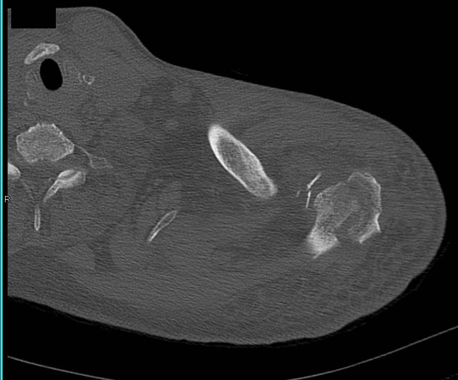 Scapular Fracture - CTisus CT Scan