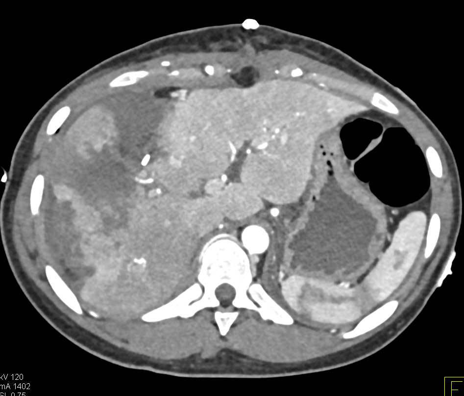 Liver Lacerations and Hemoperitoneum due to GSW - CTisus CT Scan