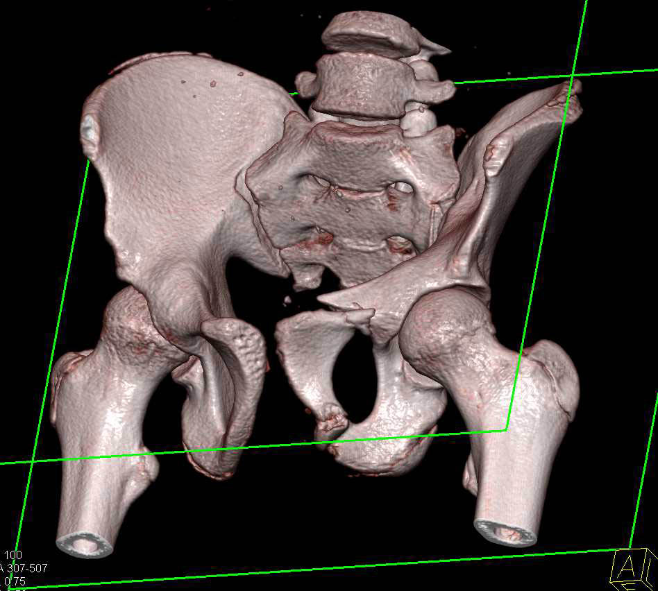 Pelvic Fractures in 3D - CTisus CT Scan