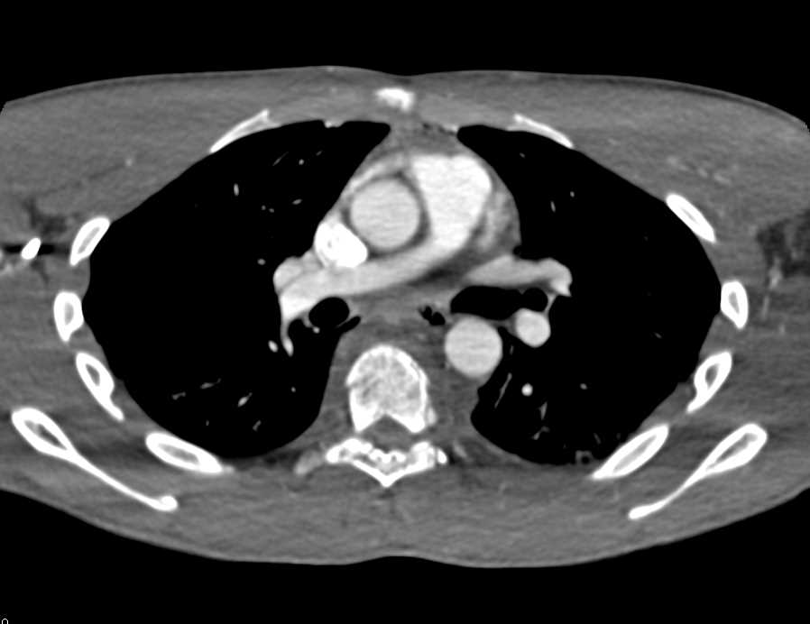 Multiorgan Trauma with T-Spine Fractures and Hematoma - CTisus CT Scan