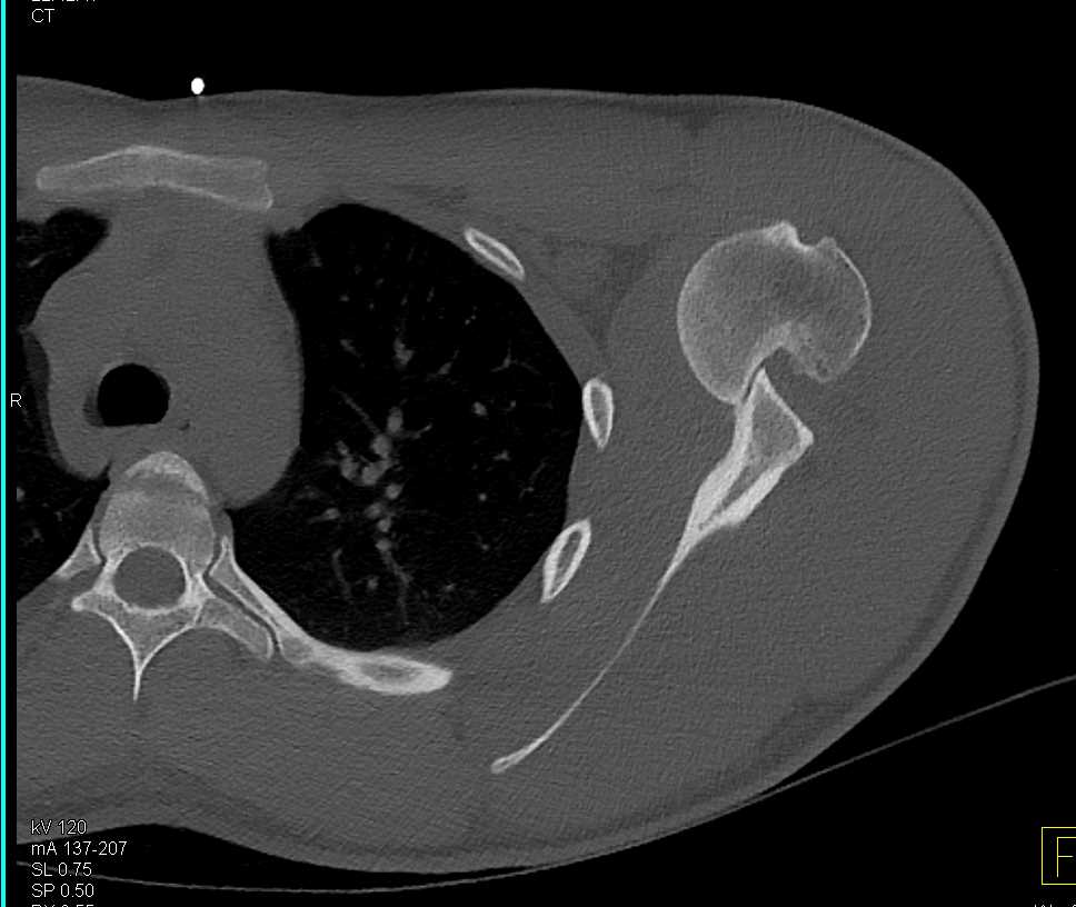 Fracture Dislocation of Left Humerus in 3D - CTisus CT Scan