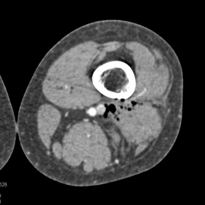 GSW Knee Without Vascular Injury with DE-CT - CTisus CT Scan