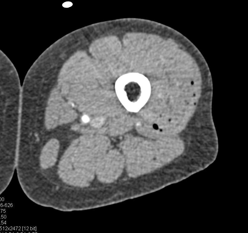 GSW Knee Without Vascular Injury with DE-CT - CTisus CT Scan