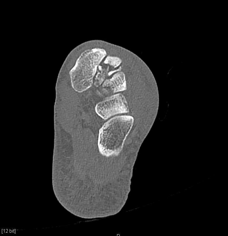 Multiple Midfoot Fractures and Dislocation - CTisus CT Scan