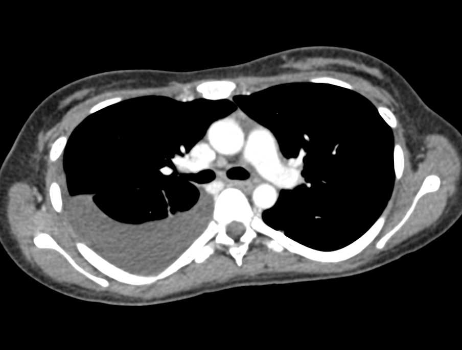 Liver Laceration in the Liver - CTisus CT Scan