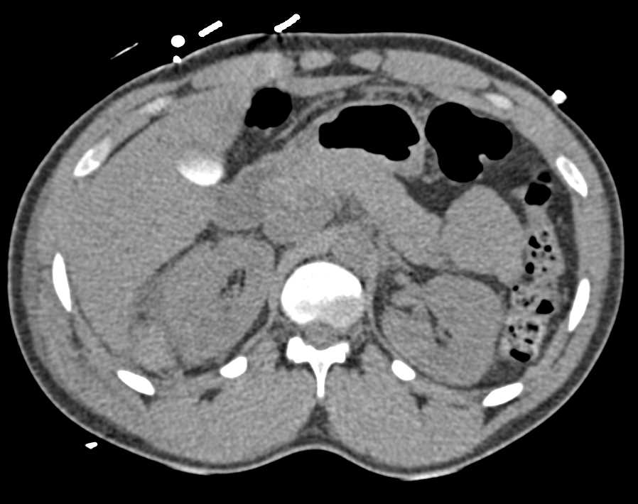 Active Bleed Right Kidney with Laceration - CTisus CT Scan