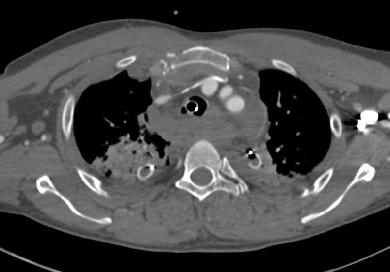 Thoracic Spine Fractures with Posterior Mediastinal Hematoma s/p Trauma - CTisus CT Scan