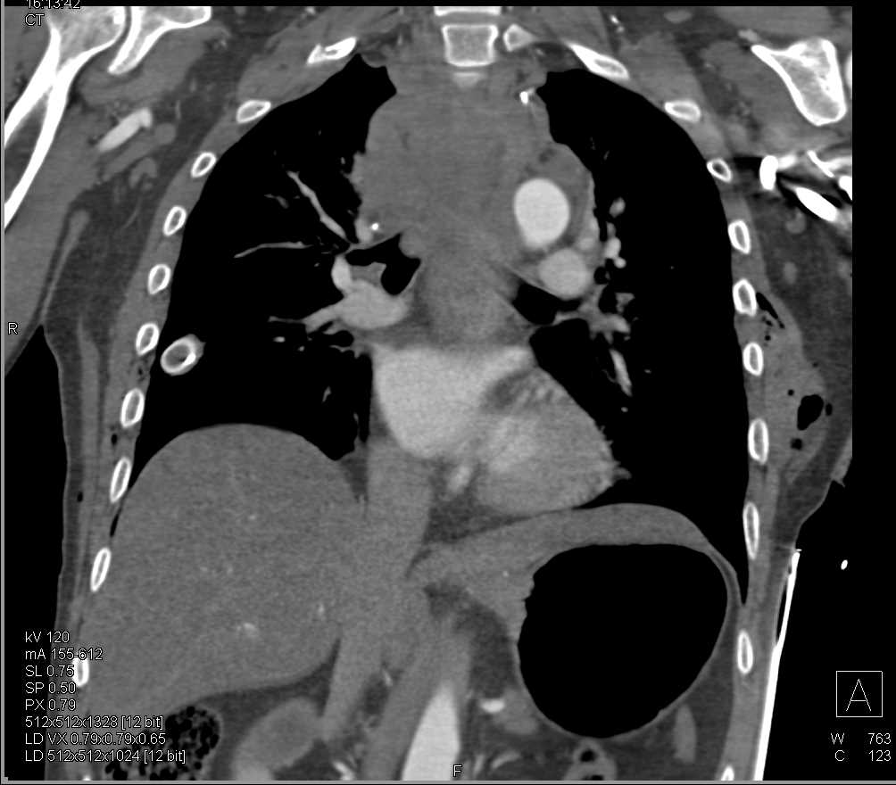 Thoracic Spine Fractures with Posterior Mediastinal Hematoma s/p Trauma and Bilateral Pneumothoraces - CTisus CT Scan