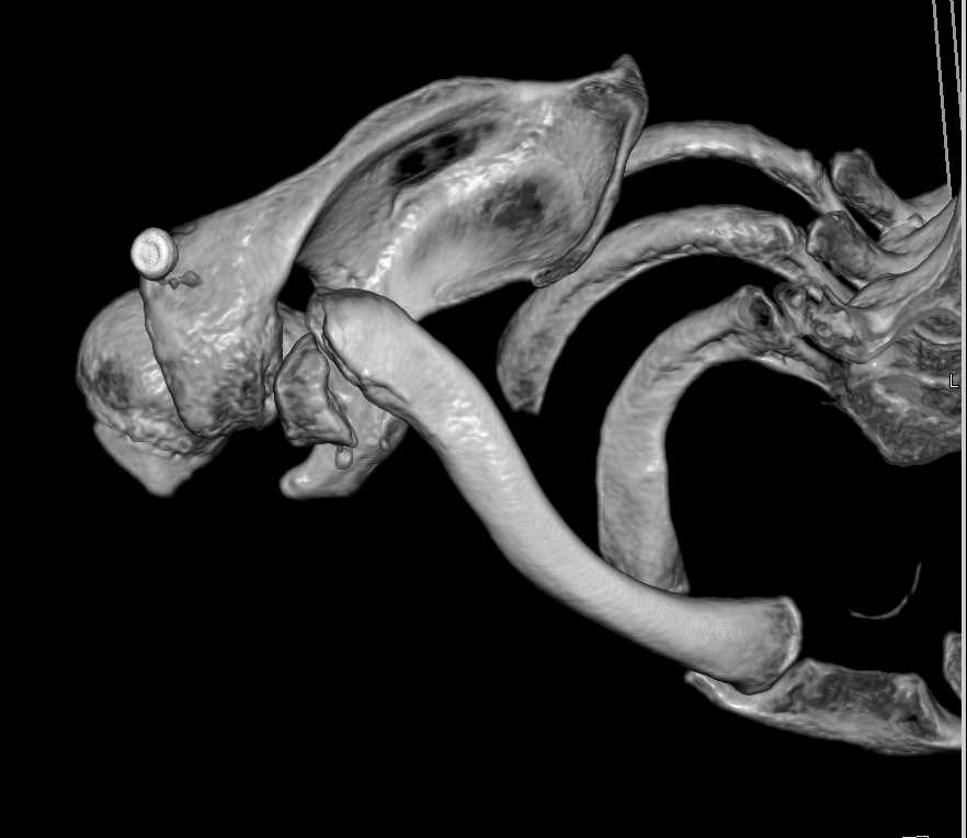 Clavicle Fracture - CTisus CT Scan