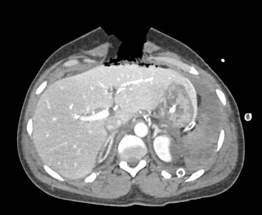 Hemoperitoneum Following Trauma with Open Wound Abdominal Wall and Pelvic Fractures - CTisus CT Scan