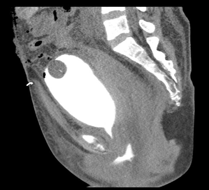 Pelvic Ring Fracture with Bladder Contrast Extravasation - CTisus CT Scan